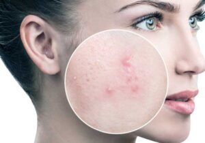 Colon Cleaning May Help Acne Sufferers