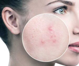 Colon Cleaning May Help Acne Sufferers