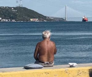 the sting of sunburn